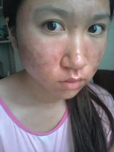 血热的症状痘痘图片8