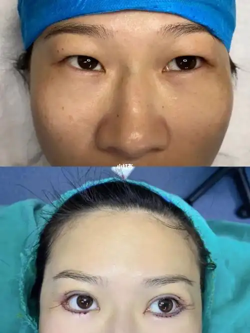 单眼皮_双眼皮_美妆_医美整形