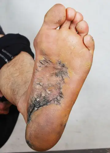 【病例讨论】严重开裂的皮肤病 [病例帖]