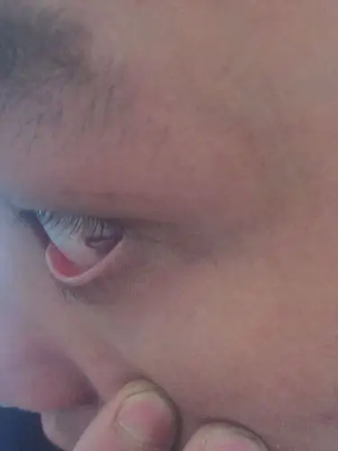 眼睛长了一个跟虫子一样的东西,这是长了什么东西啊,跪求答案