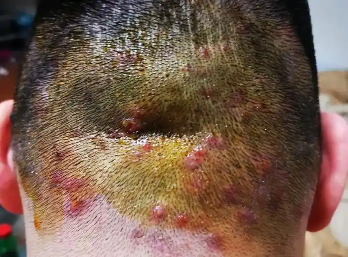 头上长红疙瘩毛囊炎怎么治疗|认识疾病选择合适的治疗方法