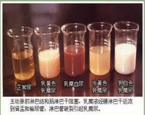 因乳糜液逆流进入尿中所致,外观呈不同程度的乳白色.