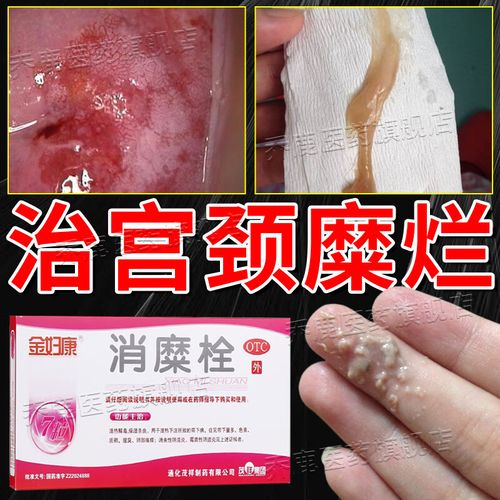 宫颈糜烂妇科用药宫颈糜烂专用药宫颈炎用药滴虫性阴道炎霉菌性阴道炎