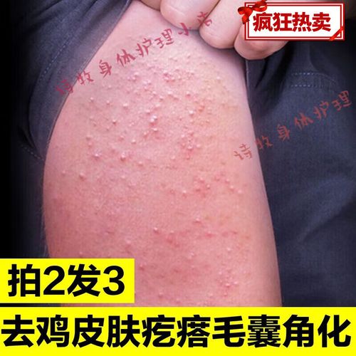 手臂上的疙瘩去鸡皮肤疙瘩毛囊角化角质胳膊上的小疙瘩 毛周角化手