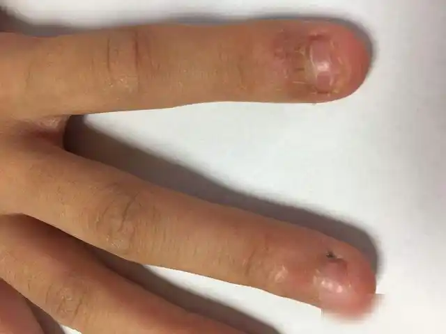 孩子"咬指甲",不只是坏习惯,放任自流可能酿成大祸_网易订阅