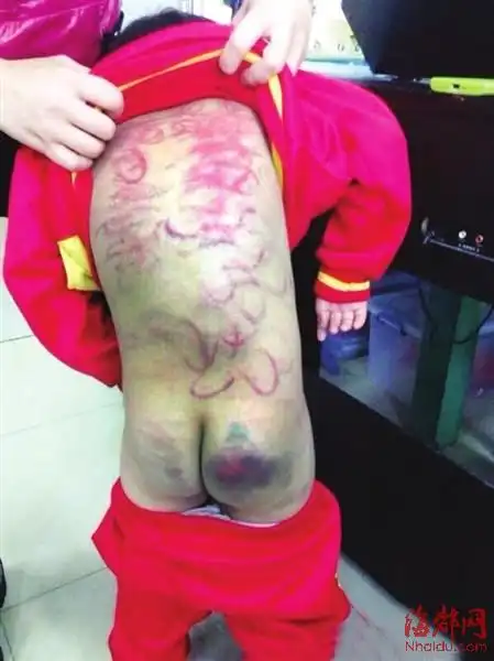 5岁女童遭母亲衣架毒打