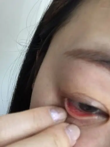 一个月前感染红眼病之后好了后下眼睑里面像是溃疡一样不痛不痒,就是