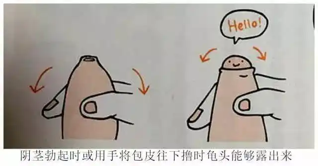 ▼包 茎下面的3幅漫画,大家可以清楚地对比一下:包皮过长和包茎是两个