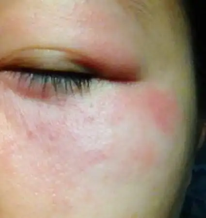 得了过敏性皮炎有啥症状