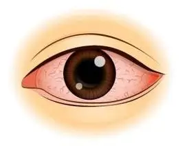 眼睛充血有什么办法缓解?朝这看过来