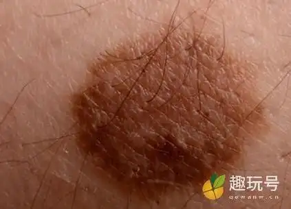 血痣和红痣的区别图片血管瘤与红痣的三大区别