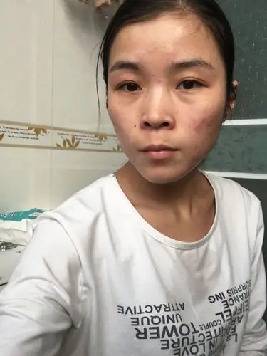 长期用bb霜导致脸发黄发黑请问还能恢复吗?