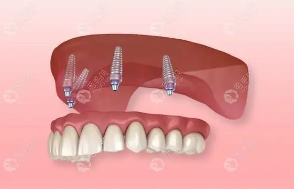 什么叫半固定种植牙?和全固定区别之一是牙冠能不能拿下来 - 口腔健康