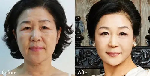 重庆华美皮肤美容院长王继文介绍,塑美极其实就是