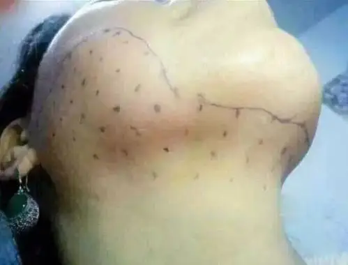 因非法注射溶脂针,我肚子肿得像怀孕5个月还差点溃烂.