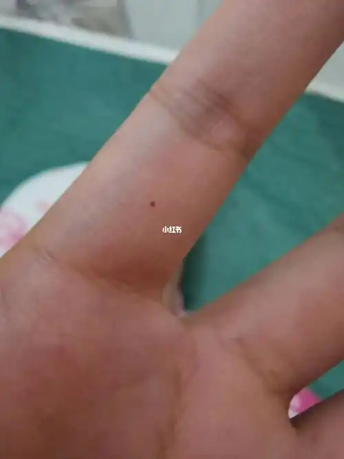 手指长痣01