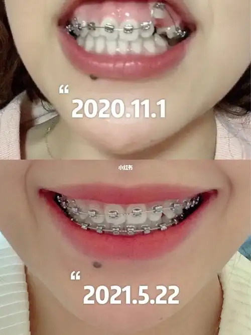 大半年了我的虎牙终于快回到自己的窝了