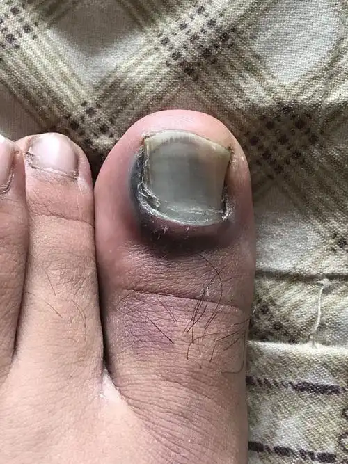 脚指甲被石头砸了一下,砸到甲床位置啦,指甲会掉吗,能想出来吗