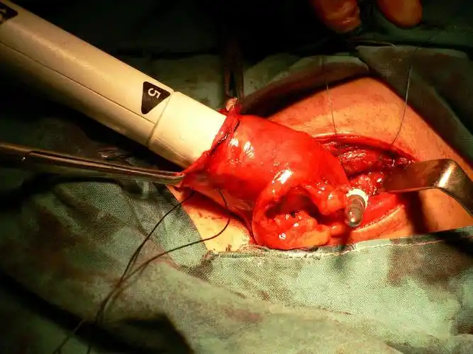 通过荷包线内洞型切口置入吻合器