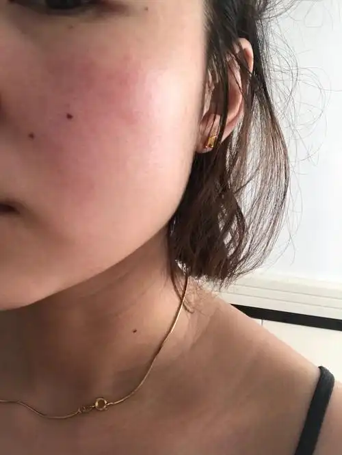 我的敏感红血丝快投降吧