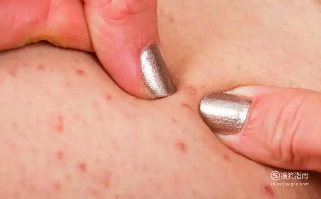 毛囊炎初期症状和图片