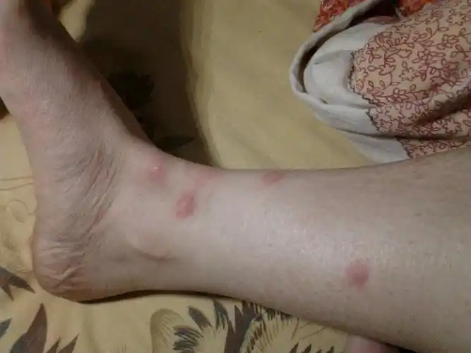 象过敏一样的红豆豆.只有脚上有一点.