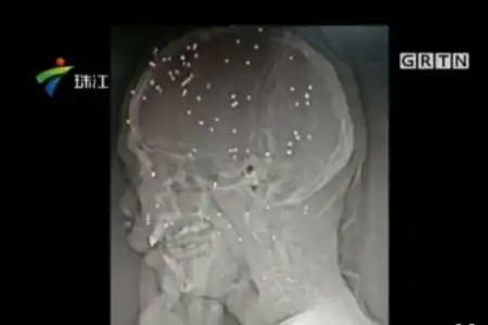 男子被霰弹枪"爆头"头部残留80颗钢珠(图)