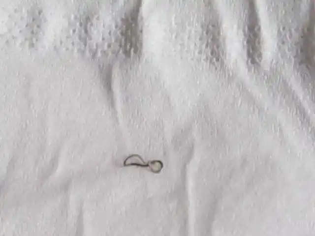 结直肠手术后吻合器的钛钉脱落是什么样的对人体有哪些影响