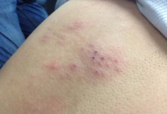 皮肤热毒图片 (30)_有来医生