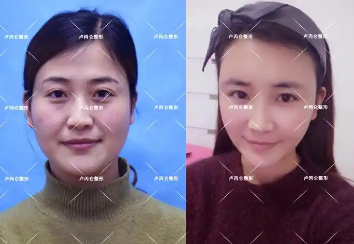 自体脂肪面部填充案例展示 - 好大夫在线