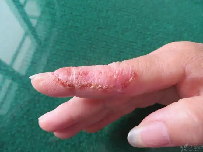 【请教】右手食指皮疹3个月了,考虑肢端皮炎?湿疹?还是真菌感染?