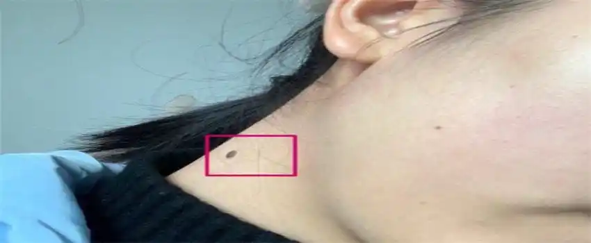 脖子上有痣代表什么(后脖有痣,脖子左侧有痣,脖子右侧有痣)