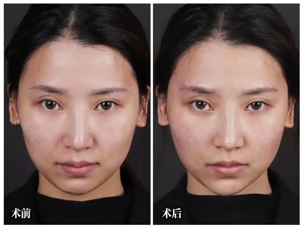 玻尿酸填充案例分享