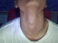 喉结下方有肿块