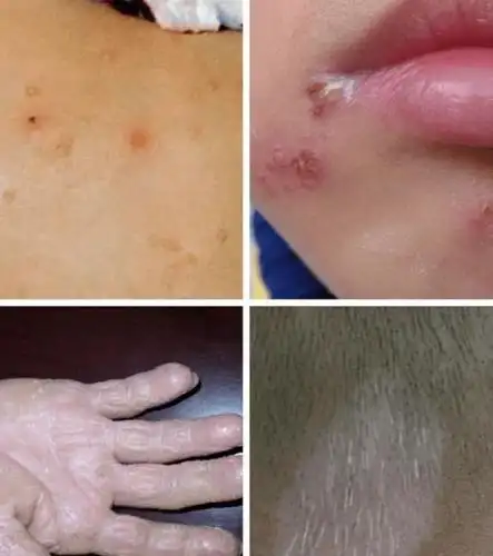 尤其是对白癜风,银屑病,痤疮,扁平疣,激素依赖性皮炎,儿童特应性皮炎