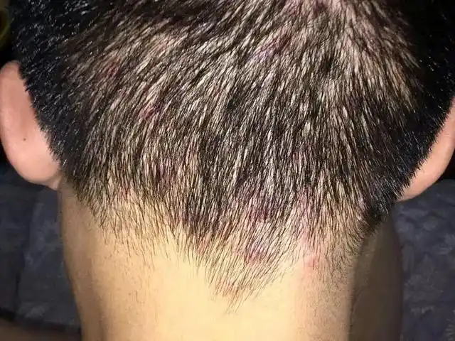 头皮脂溢性皮炎即发生在头皮的脂溢性皮炎,典型皮损是毛囊和毛囊周围