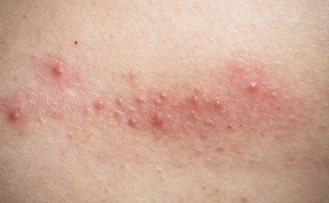 艾滋病潜伏期湿疹症状