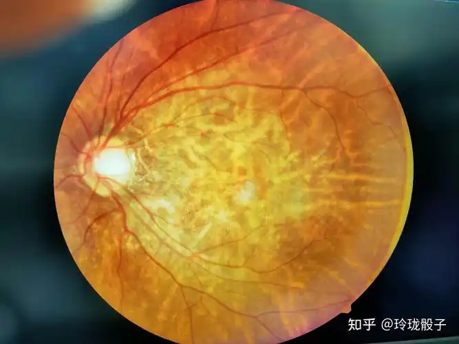 谈一谈高度近视