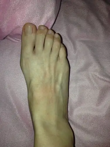 晚上睡觉突然脚背很痒,起来一看两只脚都出现了秘籍的小疙瘩,越来越多