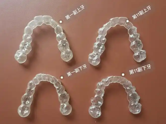 隐适美复诊,磨牙后移看的见啦