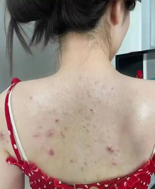 后背出油长痘怎么办?过来人紧急支招,在家轻松改善油痘肌!