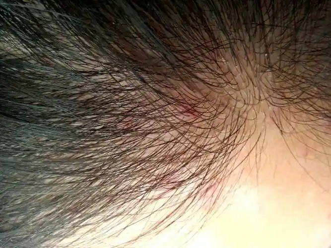 头皮长一个一个的红点是怎么回事?求医生大神!急!