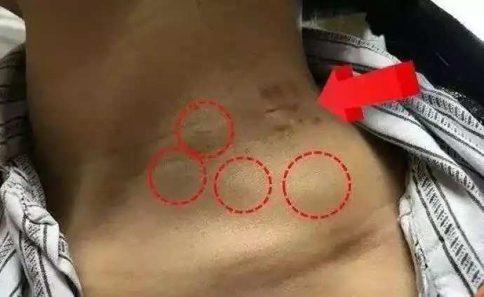 淋巴结肿大是因为毒素排不出去?如何快速排毒消肿?