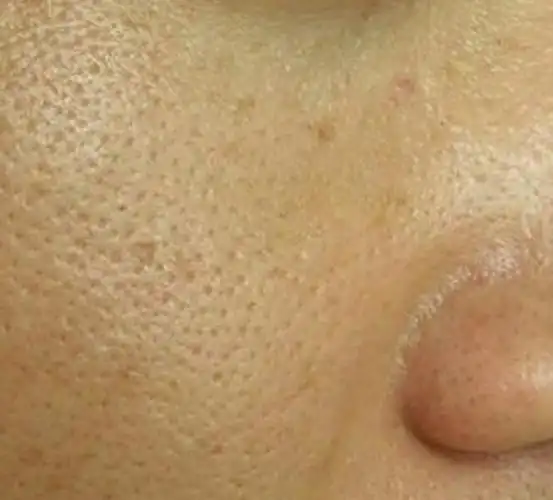 脸上毛孔粗怎么办毛孔粗大容易出油长痘如何改善