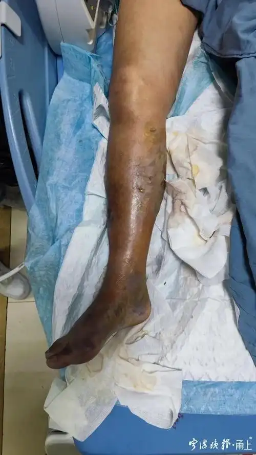 女子海边玩一下午第4天竟被截肢医生惊叹十多年没碰到过