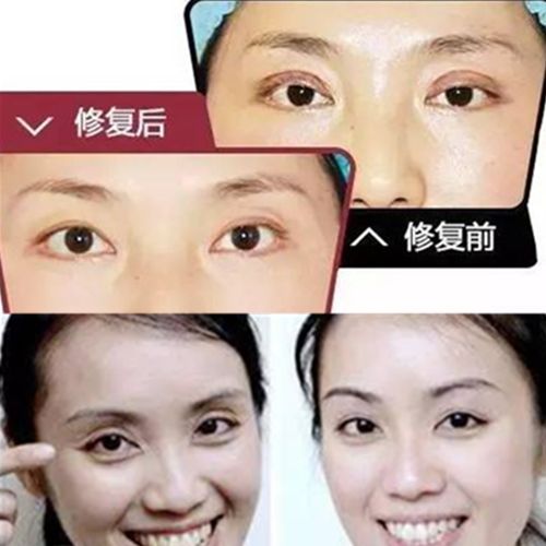 草本眼睑凹陷修复精华液  改善饱满眼部下垂 眼袋眼纹眼圈精油