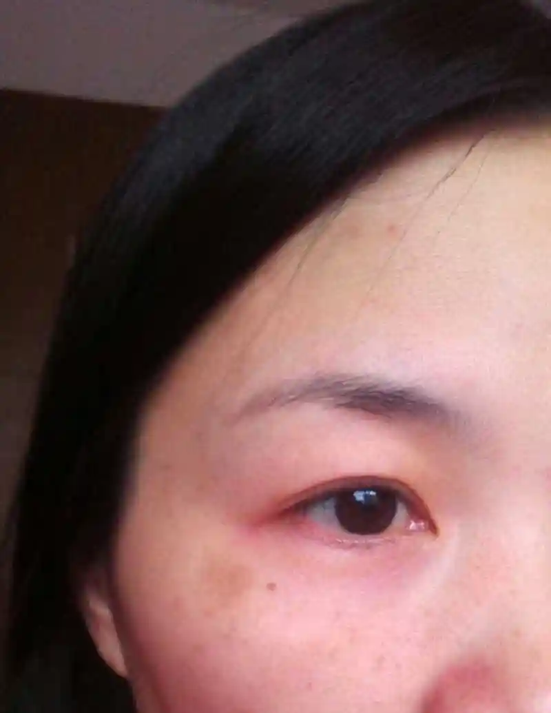 眼睛周围有斑或脂肪颗粒该怎么办?要学会科学应对