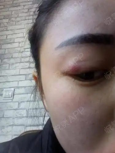 你好 医生 双眼皮埋线半年了 右眼眼尾处一直有小疙瘩 但是这次越长越