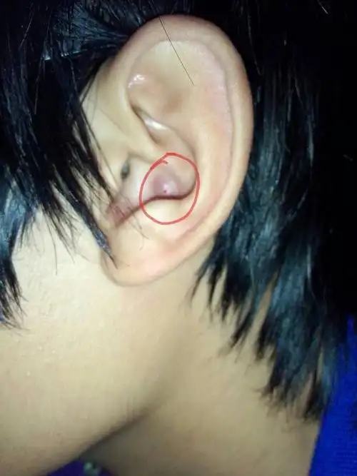问:请问这是什么问题啊,这几天耳朵里长了这么个小包.