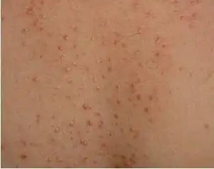 背部毛囊炎怎么治疗_毛囊炎治疗_南昌中山皮肤病医院